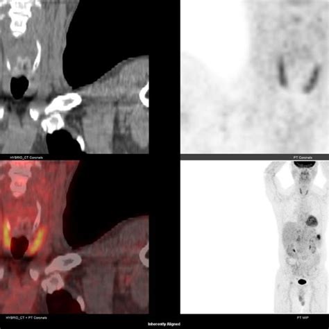 This Is A Case Of Mild Diffuse Fdg Uptake Throughout The Thyroid With