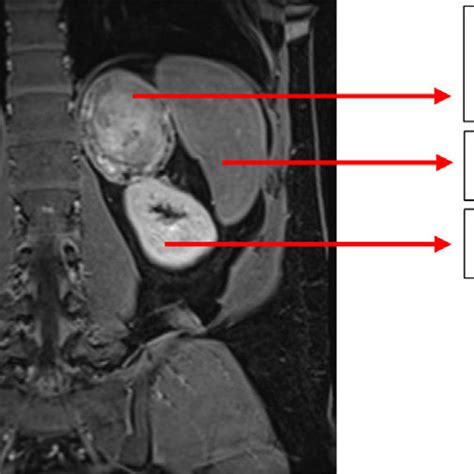 Mri Showing The Large Tumor Adjacent In Contact With The Left Kidney