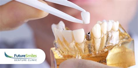 How To Take Care Of Your Calgary Dental Implant At Home