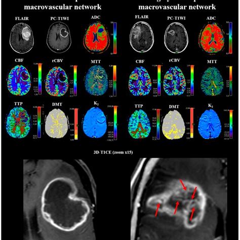 Macrovascular Network On 3d T1 Contrast Enhancement Mri Panel Of 2