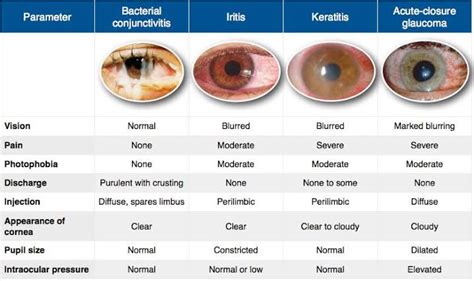 Iritis