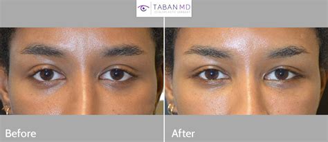 Almond Eye Surgery Before and After Gallery | Taban MD