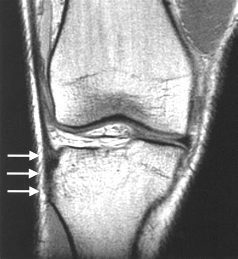 Iliotibial Band Syndrome Mri