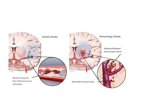 Basal ganglia stroke | PPT