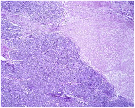 Frontiers Acinar Cell Carcinoma Of The Pancreas Overview Of