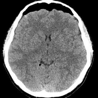 Symptomatic Pneumocephalus In Axial Cranial Ct Obtained In Postperative