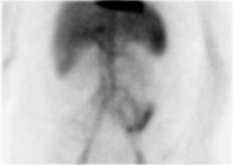 Nuclear Imaging Scan Depicting Acute Gastrointestinal Bleed Involving