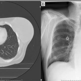 Bleeding necrotic chest wall sarcoma (A) with chest wall defect before ...