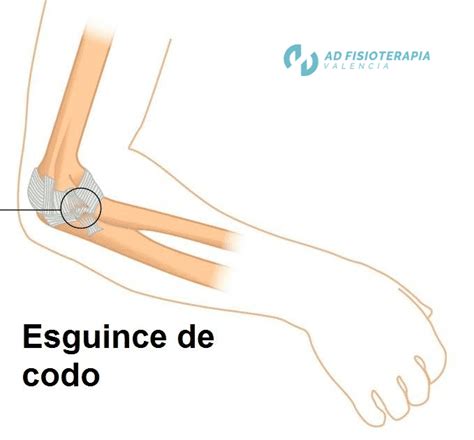 Esguince De Codo Tratamiento De Fisioterapia