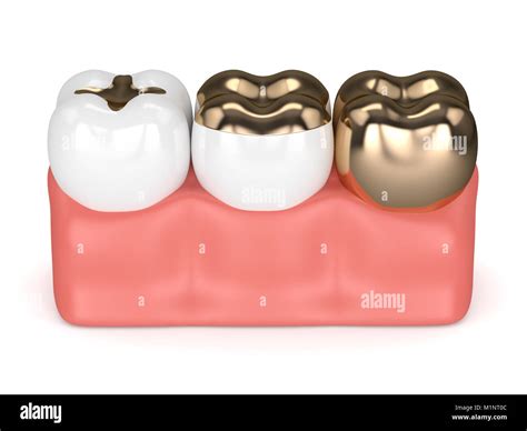 D Render Of Teeth With Inlay Onlay And Crown Gold Filling In Gums