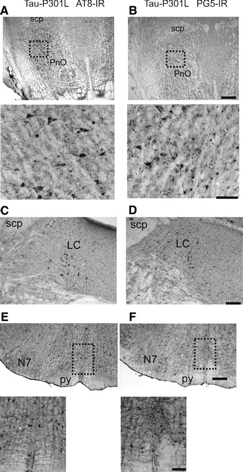 Tauopathy In Pontine Reticular Nucleus Locus Ceruleus And Raphe