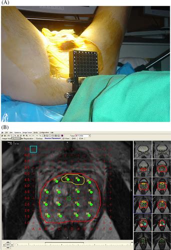 Performance Of Multiparametric Prostate Magnetic Resonance Imaging Validated By Targeted And