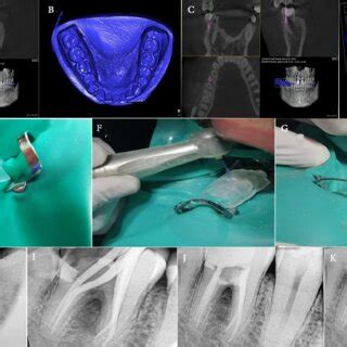 A Cbct Scan Showing Furcation Perforation B Stl File Of Cast Scan Of