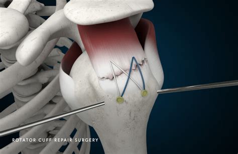 Rotator Cuff Tear Schaumburg Thomas Obermeyer Md