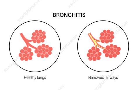 Bronchitis Lung Disease Illustration Stock Image F040 2782 Science Photo Library