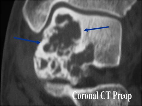 Chondroblastoma Bone Tumors Tumors Of The Bone