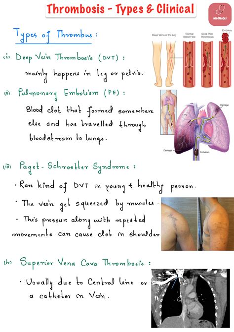 SOLUTION: 5 thrombosis types clinical - Studypool