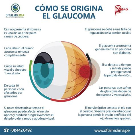 CÓmo Se Origina El Glaucoma Oftalmolima