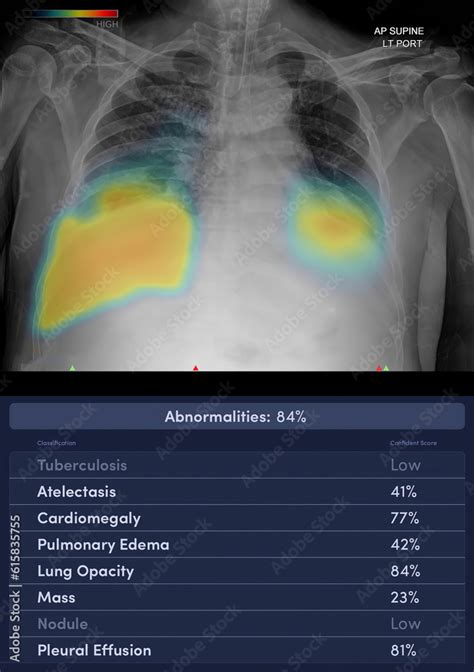 Chest x-ray image with (AI : Artificial Intelligence) report. Stock Illustration | Adobe Stock