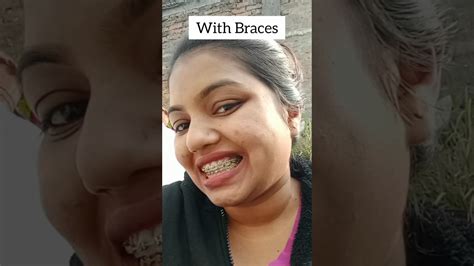 With Braces Remove Braces Braces Transformation Video Shorts