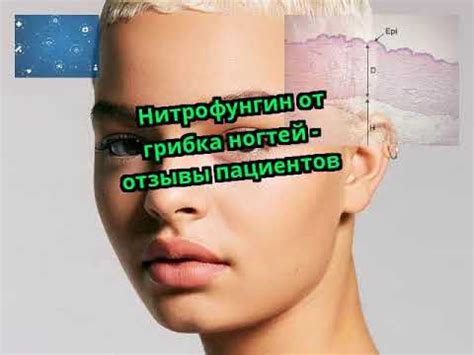 Нитрофунгин от грибка ногтей - отзывы пациентов - YouTube