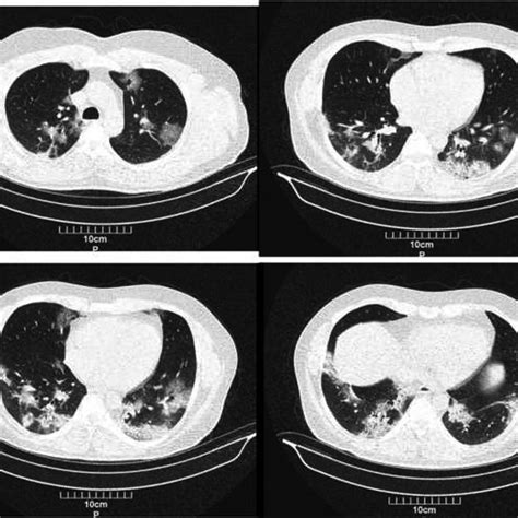 Chest Ct Scan Showing Diffuse Bilateral Ground‐glass Opacities With Download Scientific Diagram