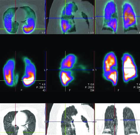 Perfusion Single Photon Emission Computed Tomography Computed