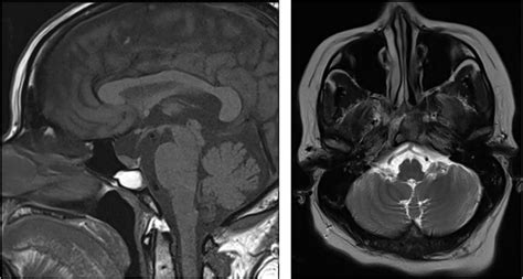 Mri Pituitary Sagittal T1 Weighted Image [t1wi] And Axial T2wi