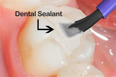 Dental Sealants Do You Need Them Are They Safe