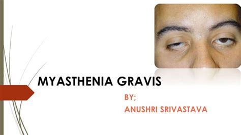 myasthenia gravis.pdf