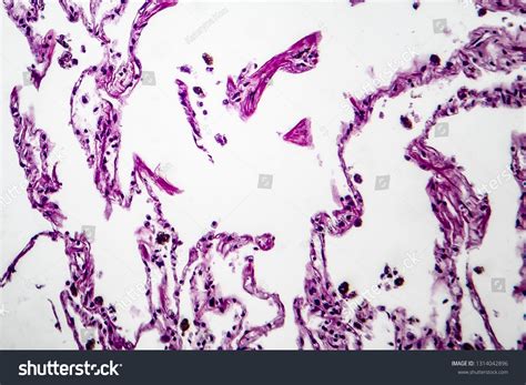 Histopathology Lung Emphysema Light Micrograph Photo Stock Photo