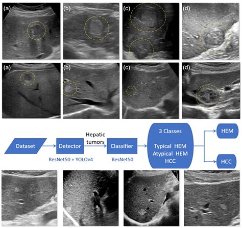 Hepatocellular Carcinoma Ultrasound