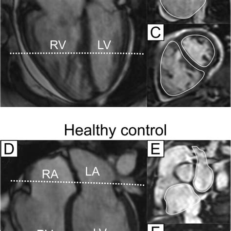 Atrial And Ventricular Delineations In Cardiovascular Magnetic