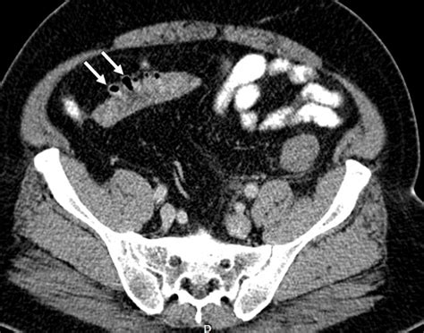 Acute diverticulitis – Radiology Cases