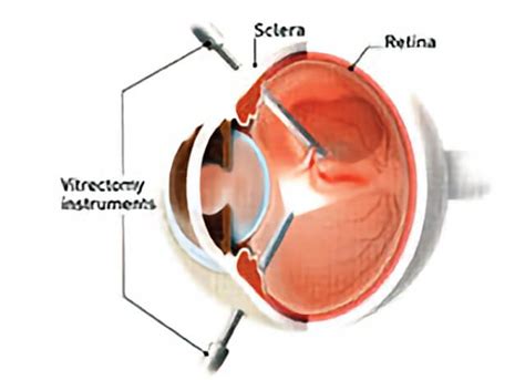 Macular Hole Treatment | Northern California Advanced Surgery Center