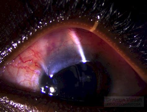 Juvenile Open Angle Glaucoma Tropical Ophthalmology