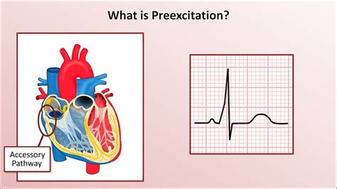 Advanced Ekgs Wolff Parkinson White Wpw Syndrome Youtube