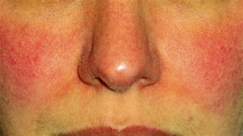 rosacea alcohol - pictures, photos