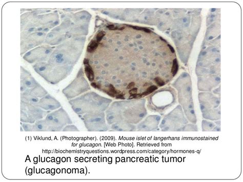 Glucagonoma