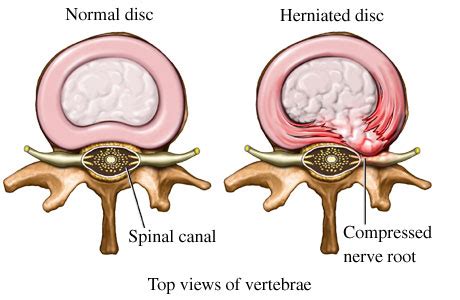 Practicing Yoga With A Herniated Disc? - Yoganatomy