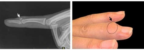 Mallet finger | www.hand-surgery.eu