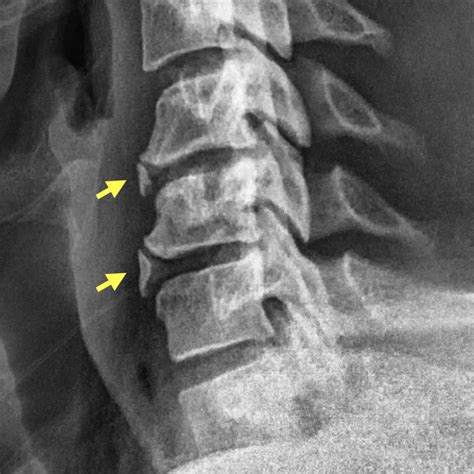 Osteophytes X Ray