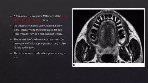 Buccal space anatomy | PPT