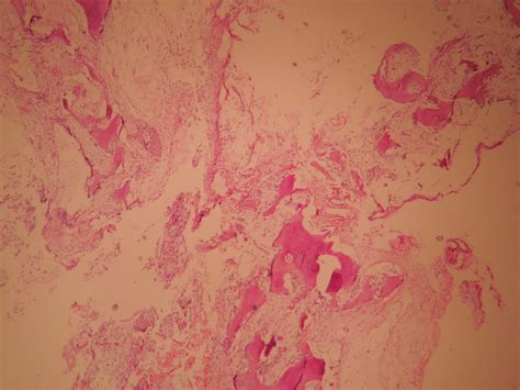 FIBROUS DYSPLASIA – Histopathology.guru