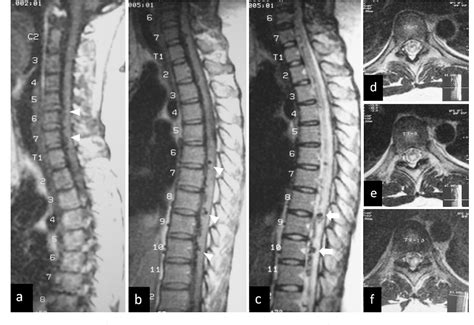 Figure 2 From Remote Intramedullary Hemorrhage In The Thoracic Spinal