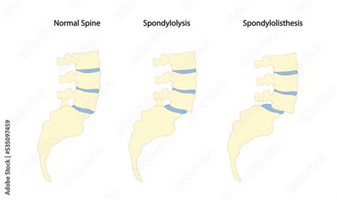 Spondylolysis And Spondylolisthesis Illustration Spine And Sacral