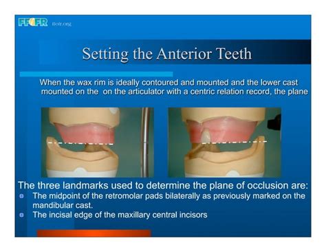 Complete Dentures 16occlusal Schemes Lingualized Occlusion Ppt