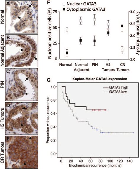 GATA3 localization and predictive value in human prostate tumors. ( A ... 
