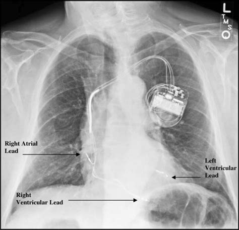 Cardiac Resynchronization Therapy Ochsner Journal