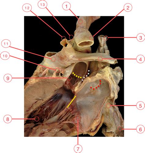 Anatomy Of Aortic Root